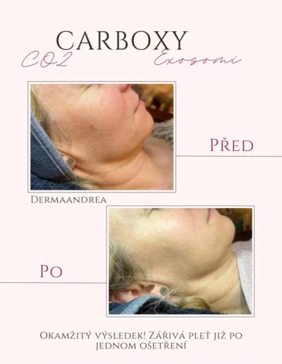 CO2 Carboxy exosomi