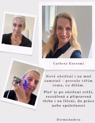 CO2 Carboxy exosomi